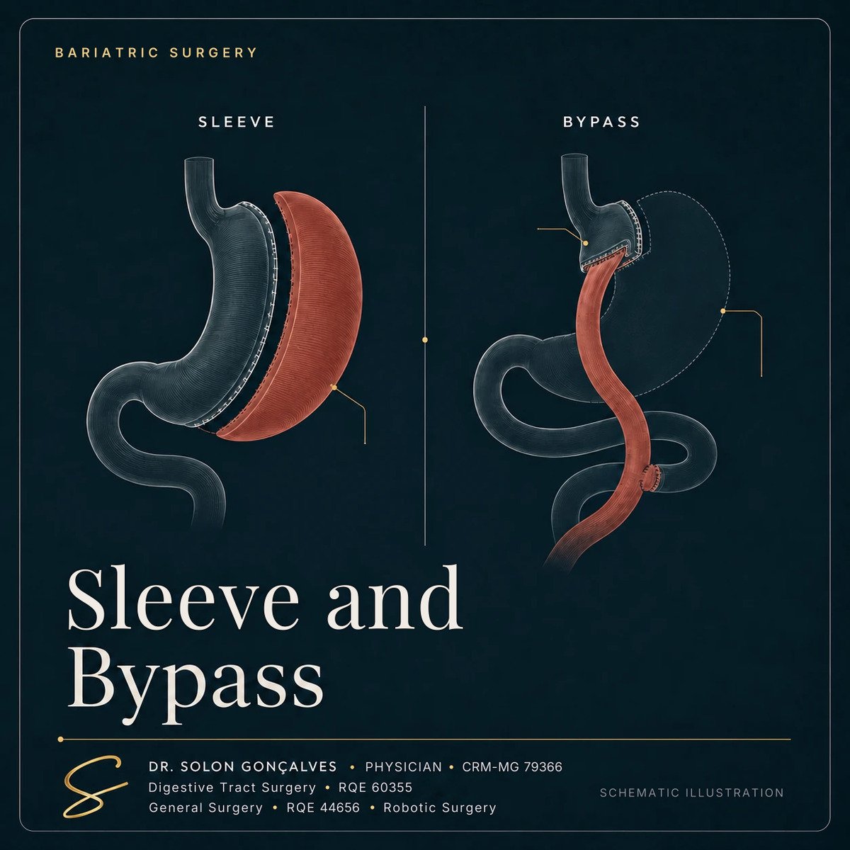 Schematic illustration of the two bariatric techniques: sleeve gastrectomy and Roux-en-Y gastric bypass