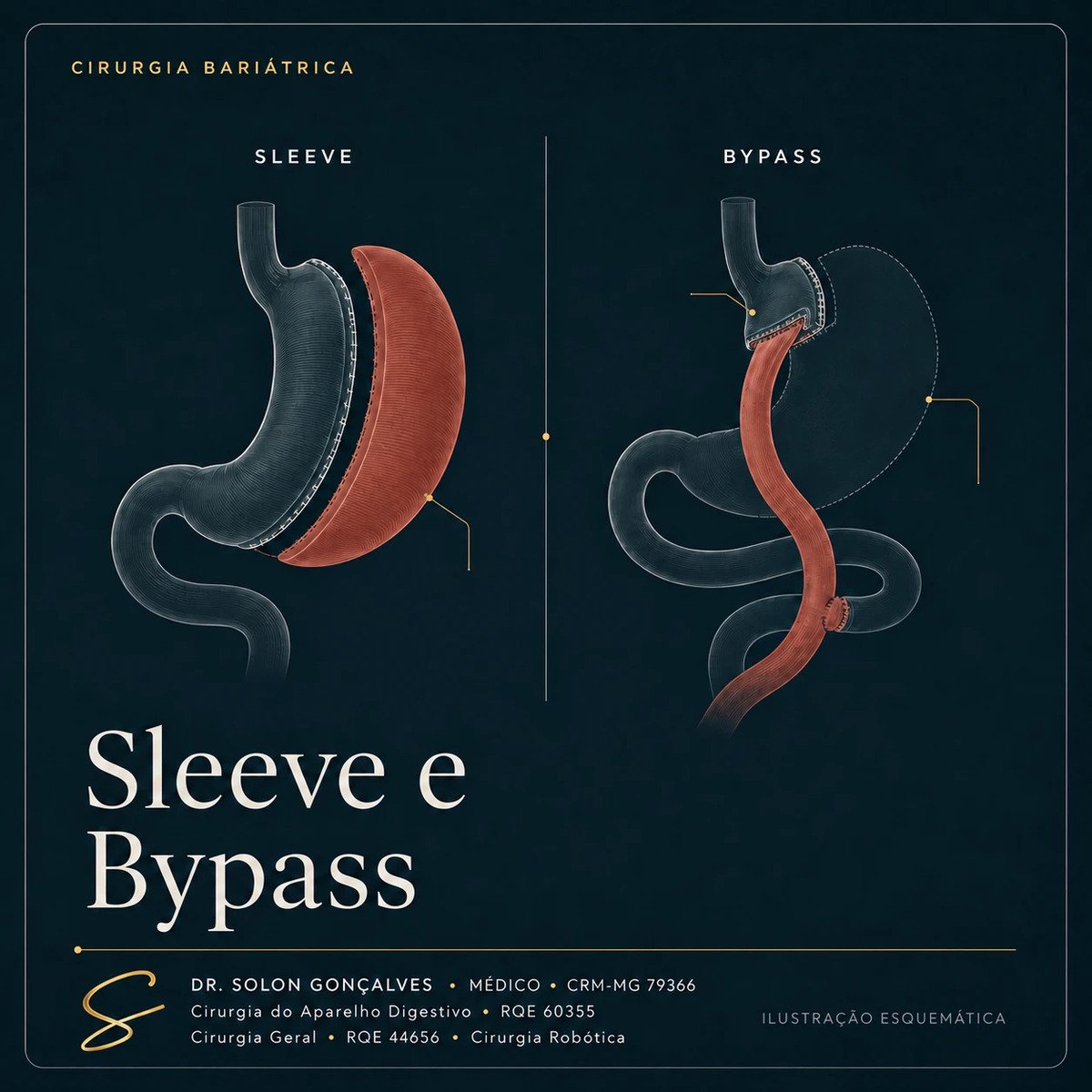 Ilustração esquemática das duas técnicas bariátricas: gastrectomia vertical (sleeve) e bypass gástrico em Y de Roux
