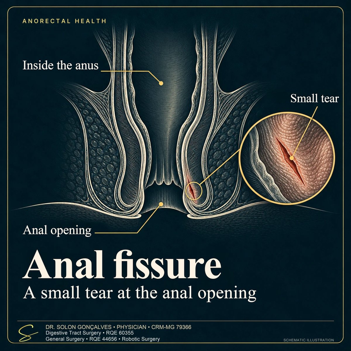Sectional illustration of the anal canal with an anal fissure at the anal opening and a close-up of the small tear
