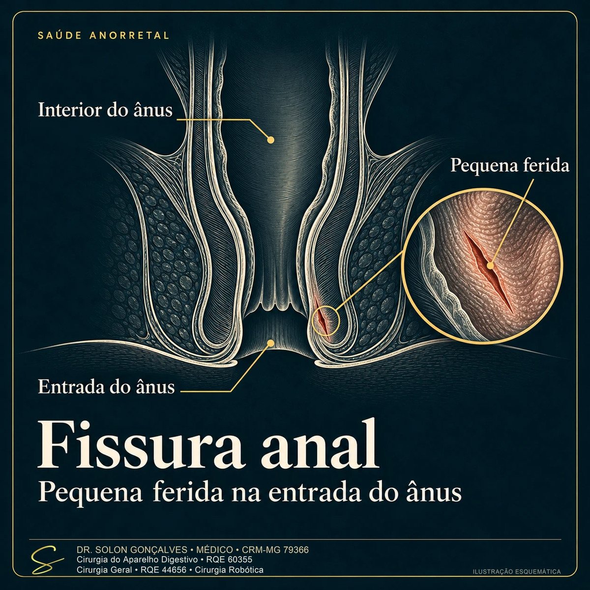 Ilustração em corte do canal anal com a fissura anal na entrada do ânus e detalhe ampliado da pequena ferida