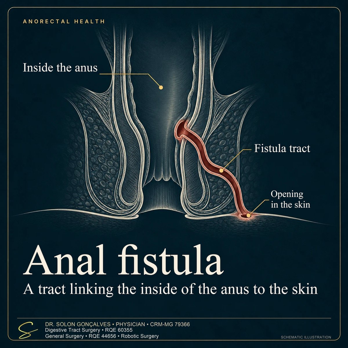 Sectional illustration of the anal canal with an anal fistula tract, from the inside of the anus to its opening in the skin