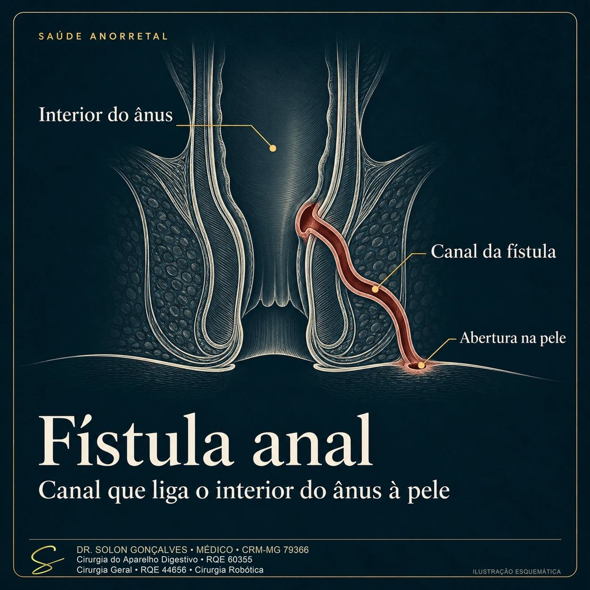 Ilustração em corte do canal anal com o trajeto de uma fístula anal, do interior do ânus até a abertura na pele