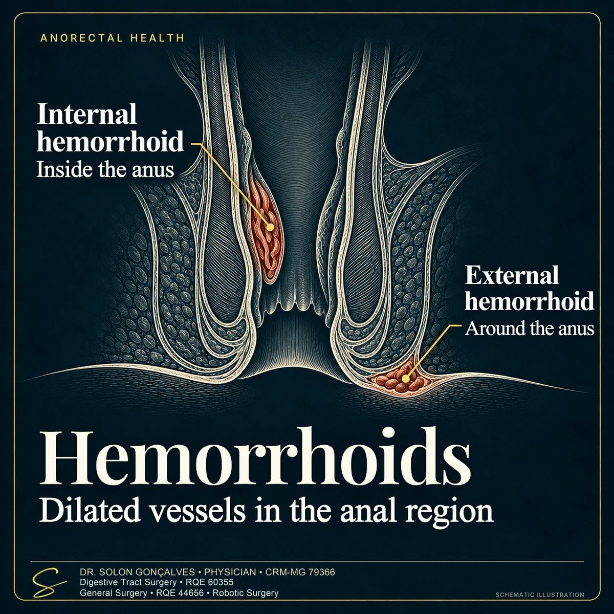 Sectional illustration of the anal canal with an internal hemorrhoid, inside the anus, and an external hemorrhoid, around the anus