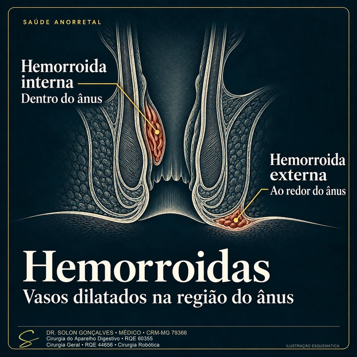 Ilustração em corte do canal anal com hemorroida interna, dentro do ânus, e hemorroida externa, ao redor do ânus