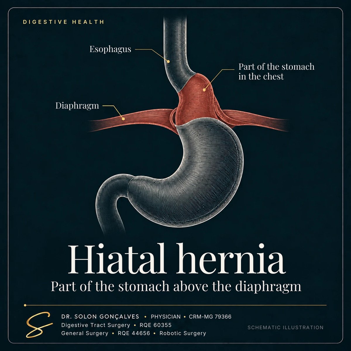 Illustration of a hiatal hernia: part of the stomach above the diaphragm, inside the chest