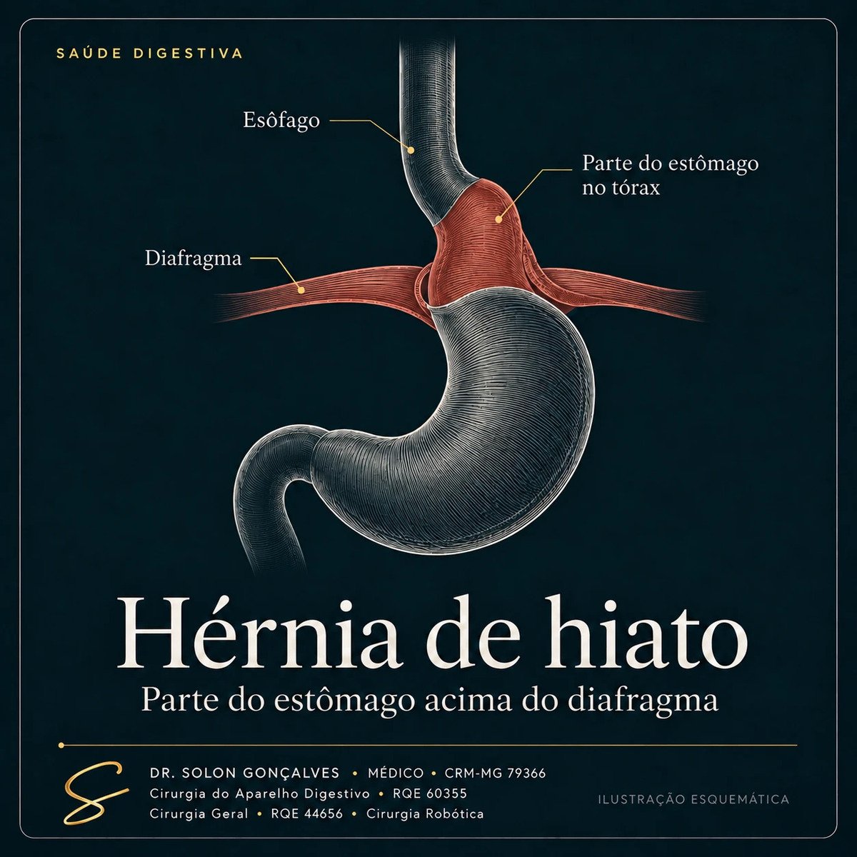 Ilustração da hérnia de hiato: parte do estômago acima do diafragma, dentro do tórax