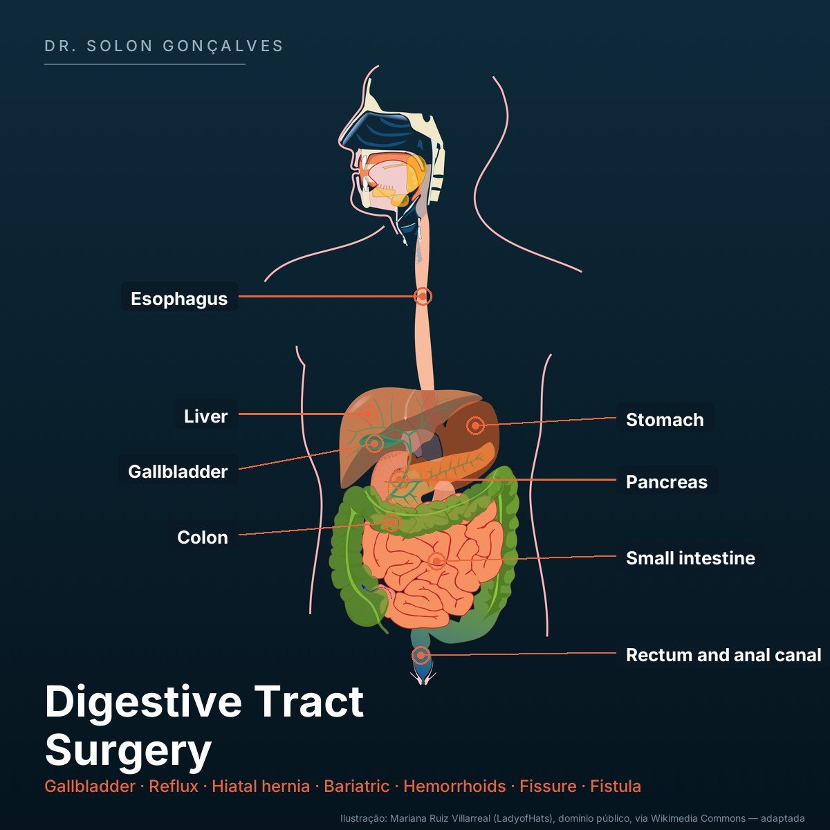 Illustration of the digestive tract with the areas treated by digestive tract surgery