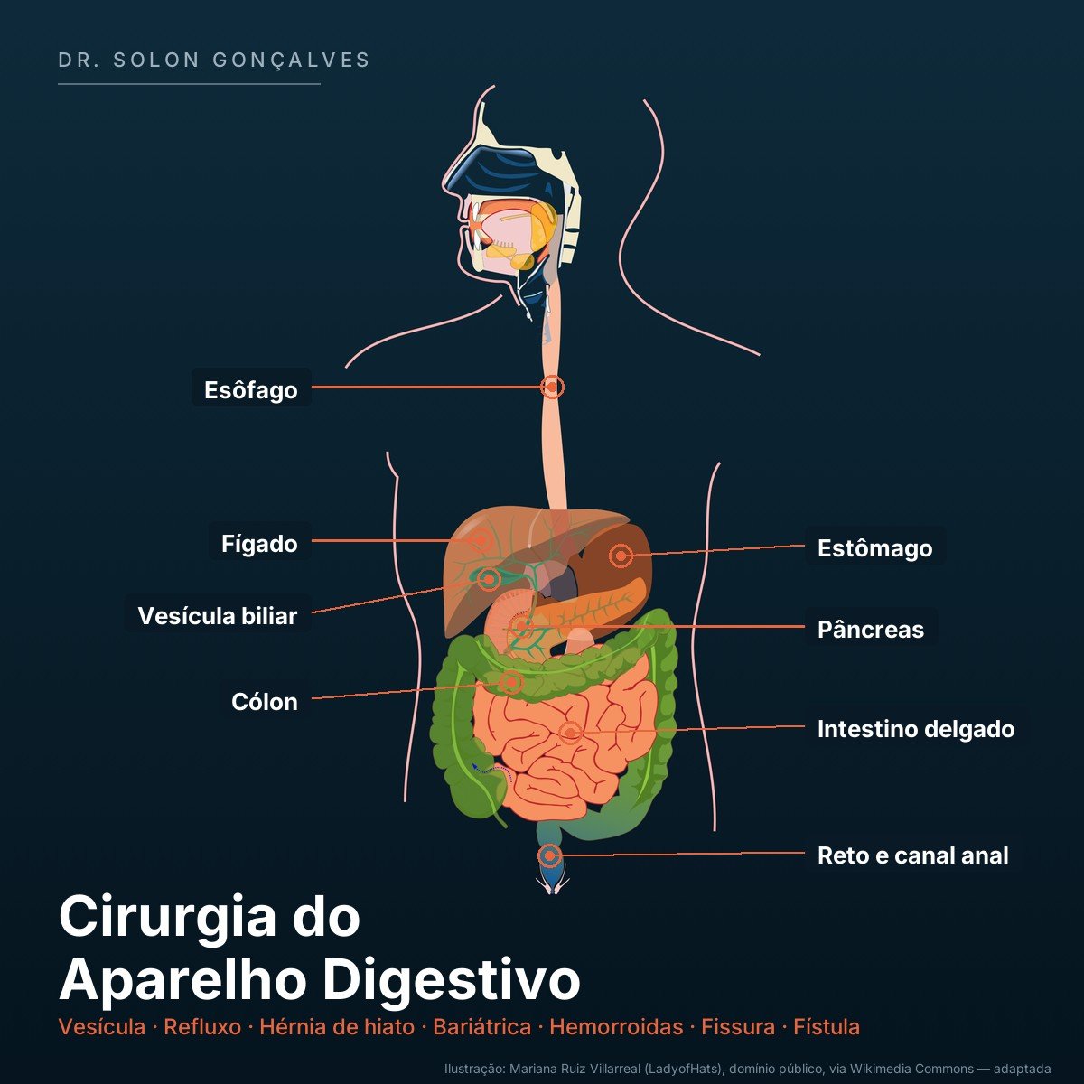 Ilustração do aparelho digestivo com as áreas tratadas pela cirurgia do aparelho digestivo