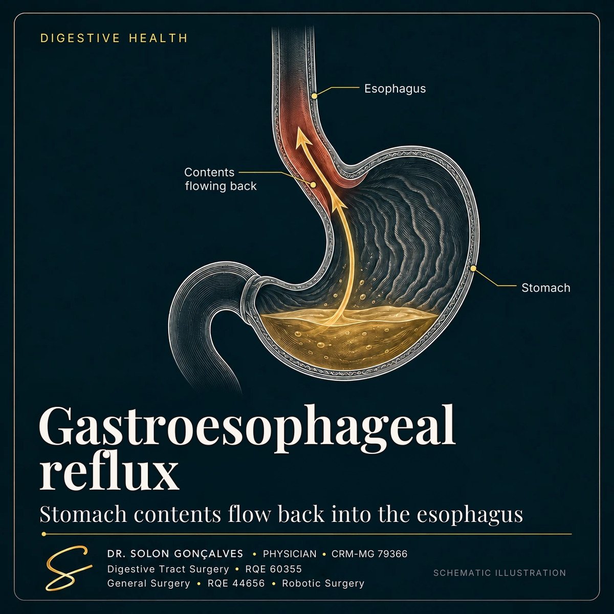 Illustration of gastroesophageal reflux: stomach contents flowing back into the esophagus, with an inflamed lining