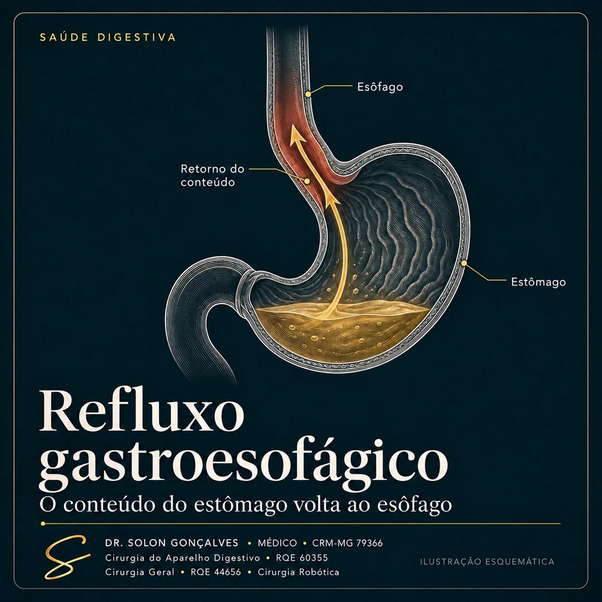 Ilustração do refluxo gastroesofágico: o conteúdo do estômago voltando ao esôfago, com a mucosa inflamada