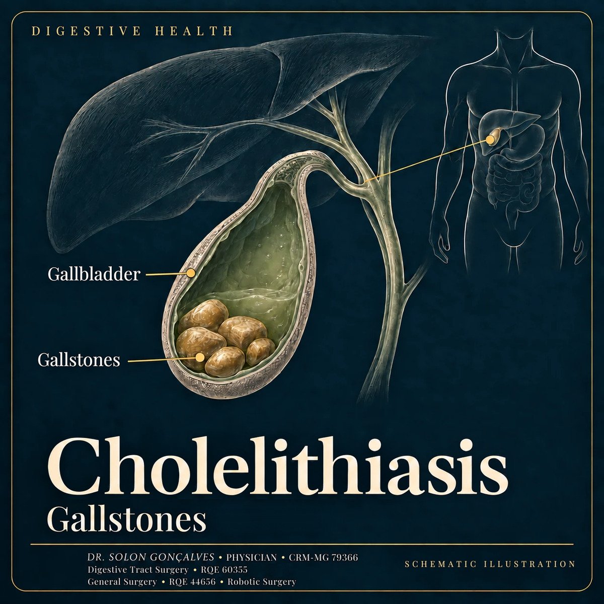 Illustration of the gallbladder with stones, under the liver, with the bile ducts and its location in the body