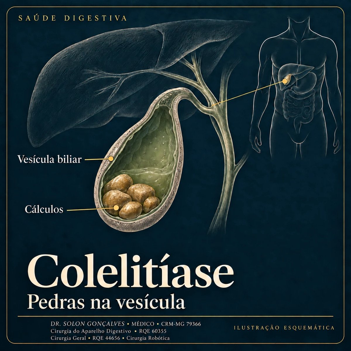 Ilustração da vesícula biliar com cálculos, sob o fígado, com as vias biliares e a localização no corpo